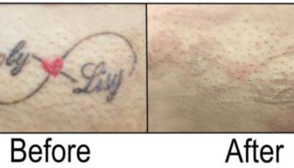 Four Tips to Choose the Best Tattoo Removal Cream