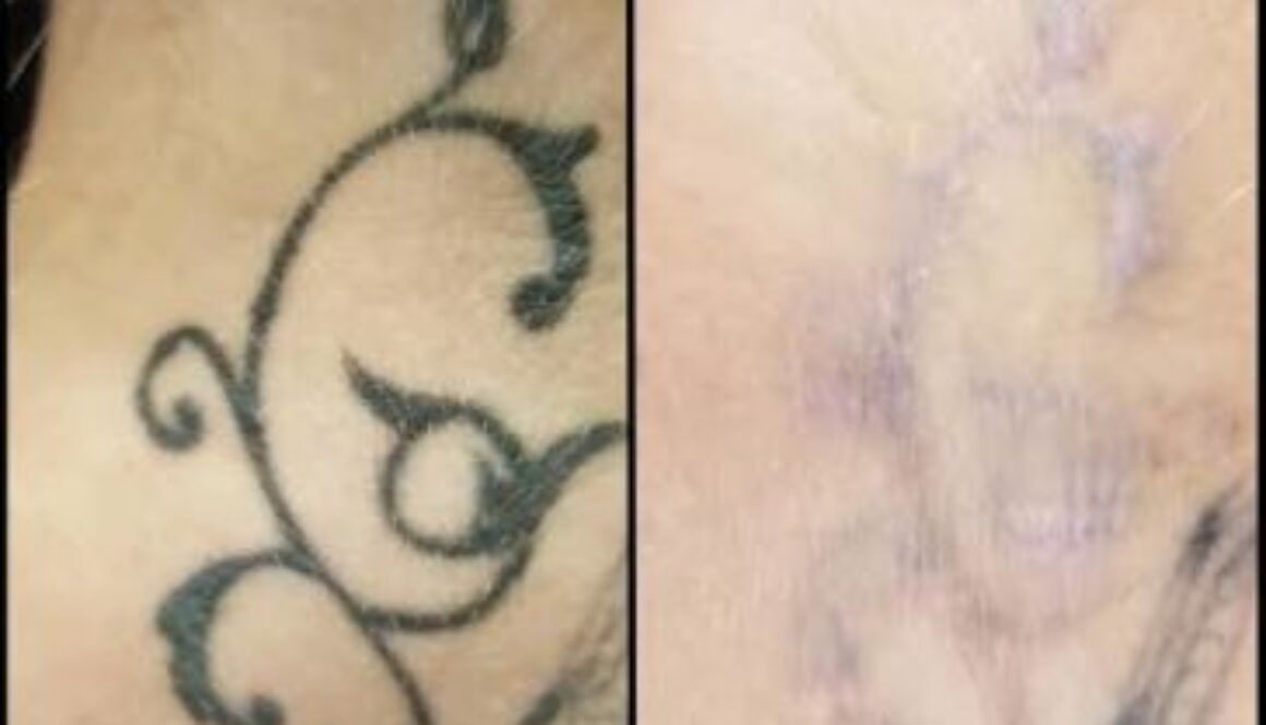 Tattoo Removal – Different Methods to Assist You to Clear Away a Tattoo