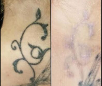 Tattoo Removal – Different Methods to Assist You to Clear Away a Tattoo